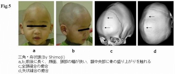 後頭部 へこみ 赤ちゃん